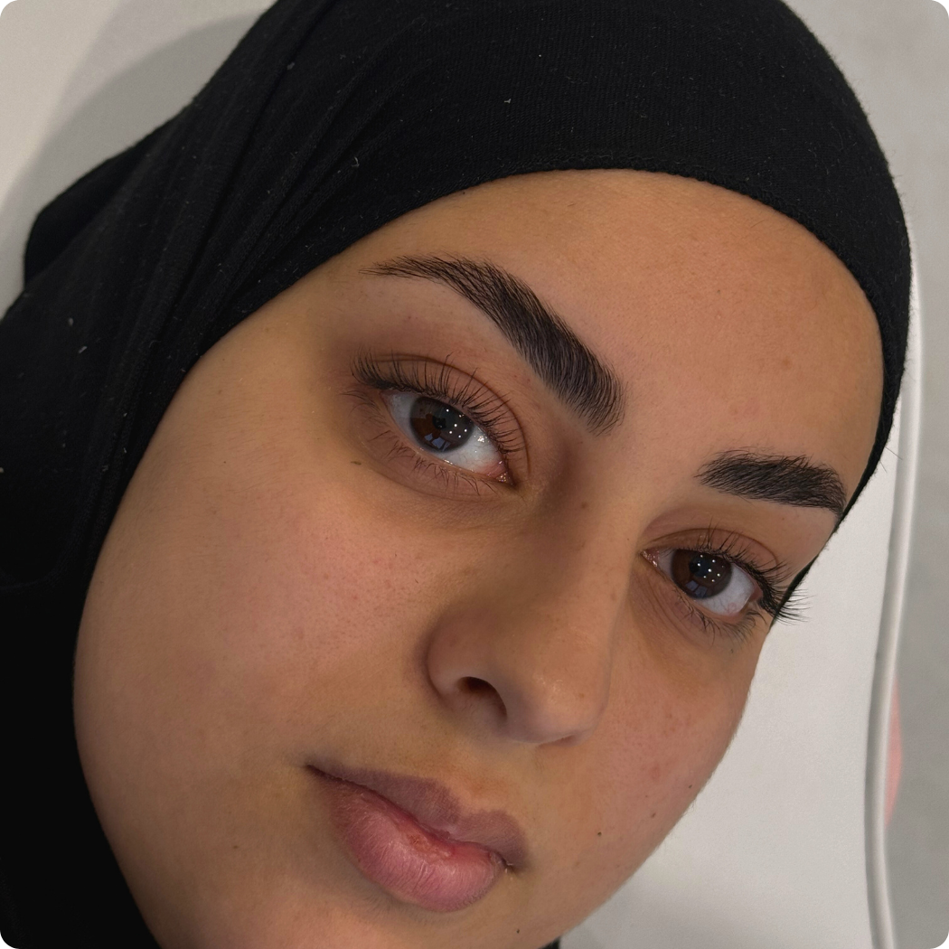 browlifting