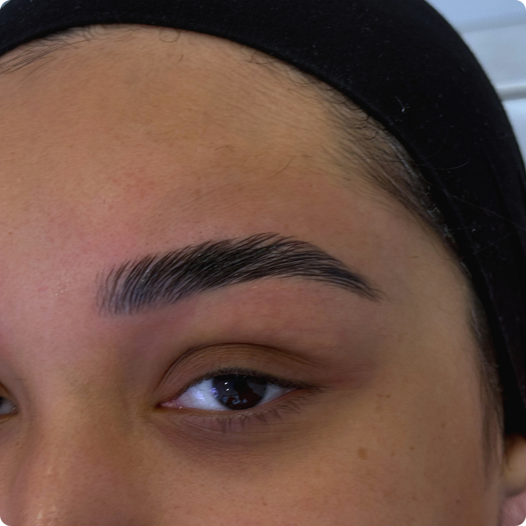 browlifting