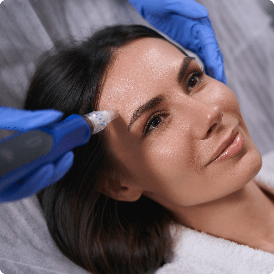 microneedling
